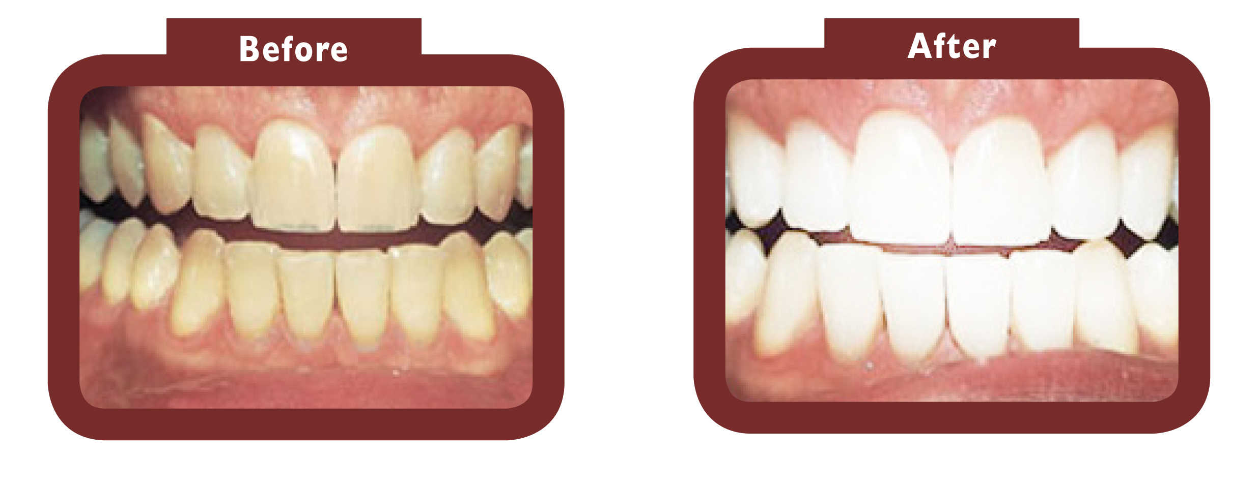 See LA Teeth Whitening before and after results. Contact our team today! Brackley