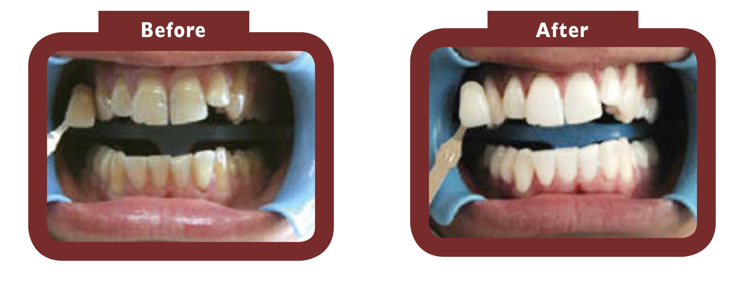 Before and after teeth whitening Brackley - LA TEETH Brackley