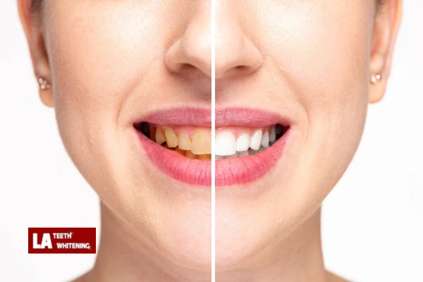 About Us At LA Teeth Whitening Brackley Contact us today! Brackley
