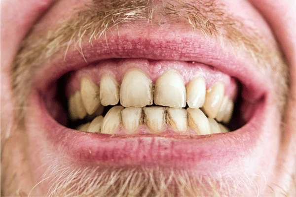Why Do Lifestyle Habits Like Coffee, Wine, and Smoking Shorten Whitening Results Brackley