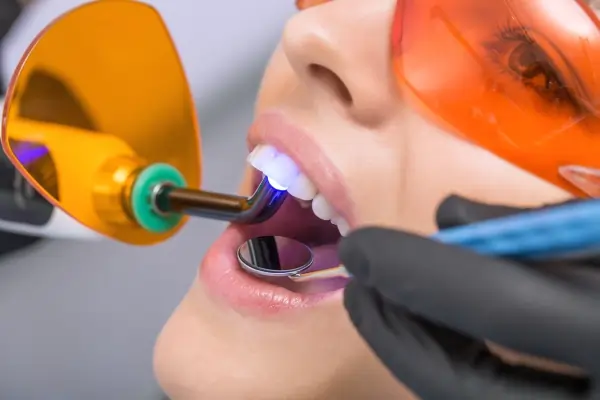 How Long Does Laser Teeth Whitening Last Brackley
