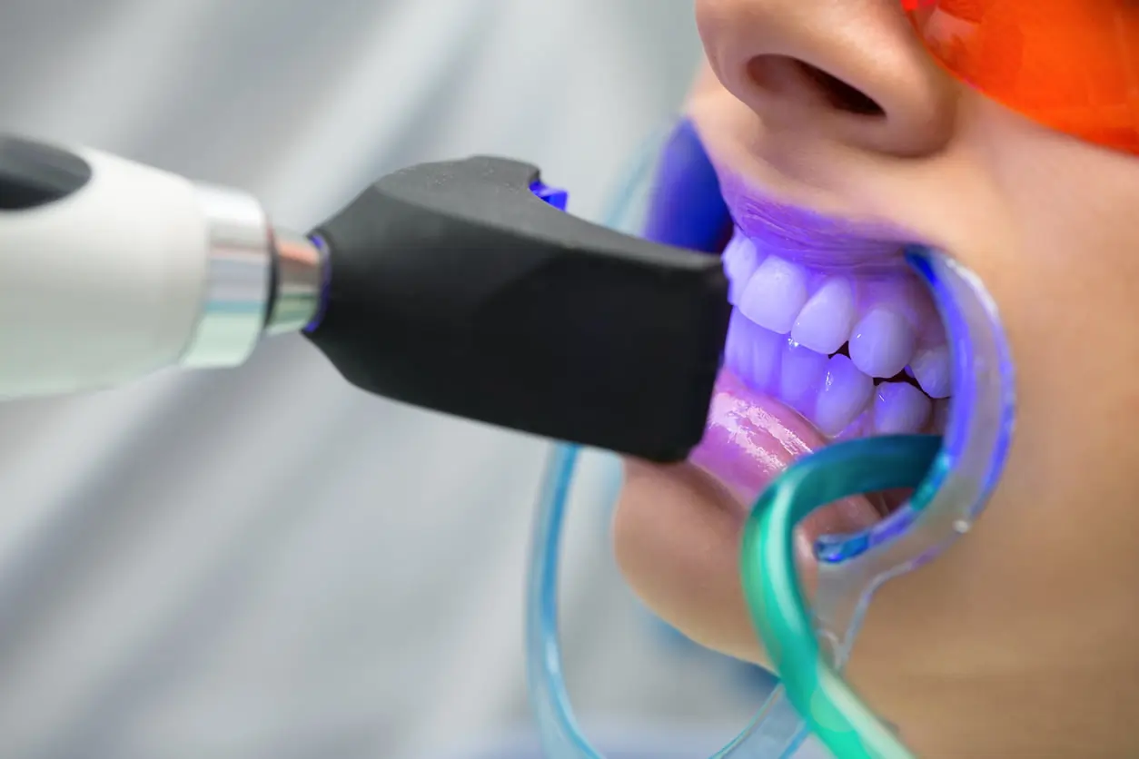 How Does LA Teeth Whitening Combine Safety, Comfort, and Professional Results Brackley