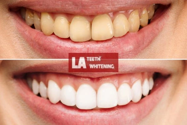 Before and after results - smokers stained teeth results! Brackley