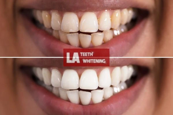 Fast and effective whitening results in one hour. Contact LA Teeth Whitening Brackley to book online Brackley