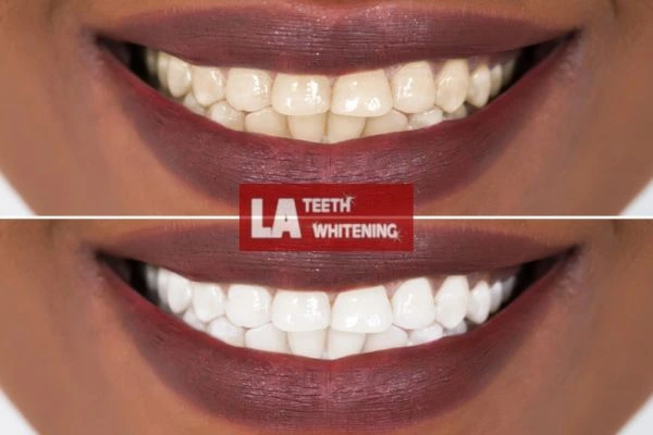 Brighter and white smile - before and after results Brackley book online today! Brackley