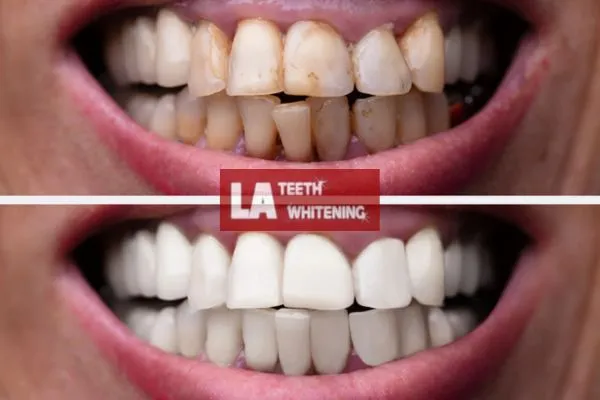 Customer results from LA Teeth Whitening Brackley Book today. Brackley