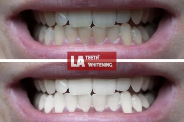 Mens before and after of teeth whitening results Brackley Brackley