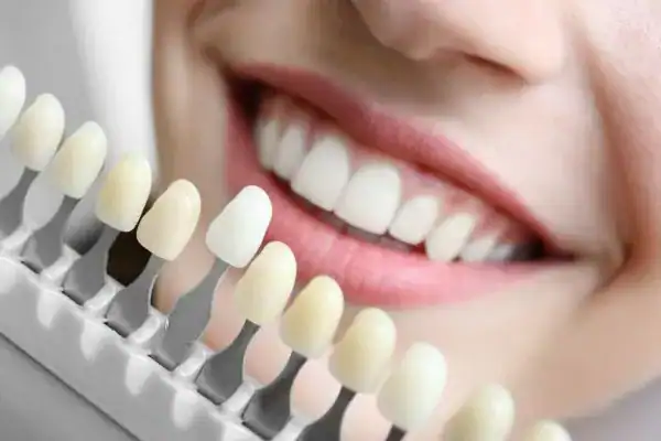 laser whitening Faqs Brackley